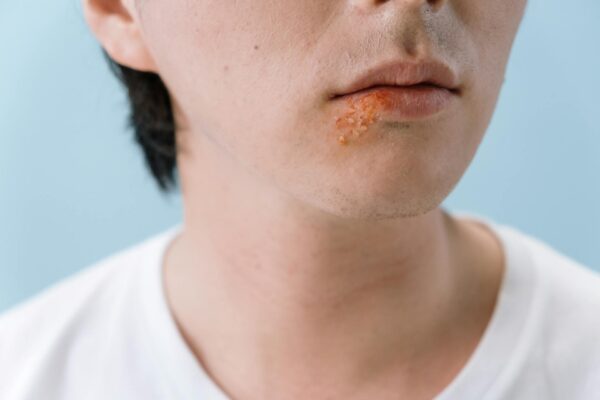 Taking a Closer Look at MRSA Symptoms and Treatments with Doctronic